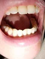 (69)【原创】老姐拔智齿了,痛了两天还没好。心烦……2