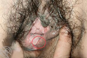 丈母娘的阴道疱疹0