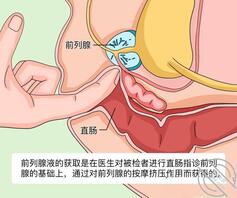 在男科取过前列腺液,才知道自己的深浅1