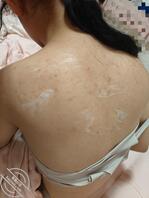 女儿青春期的身体最近长了痘痘1